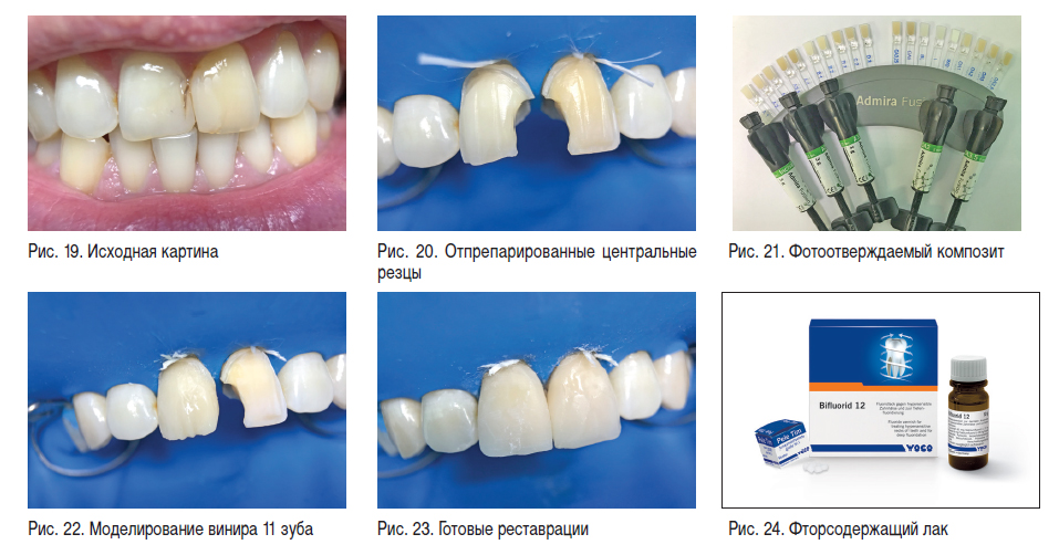 Покрытие фторсодержащее и фторлак для зубов купить